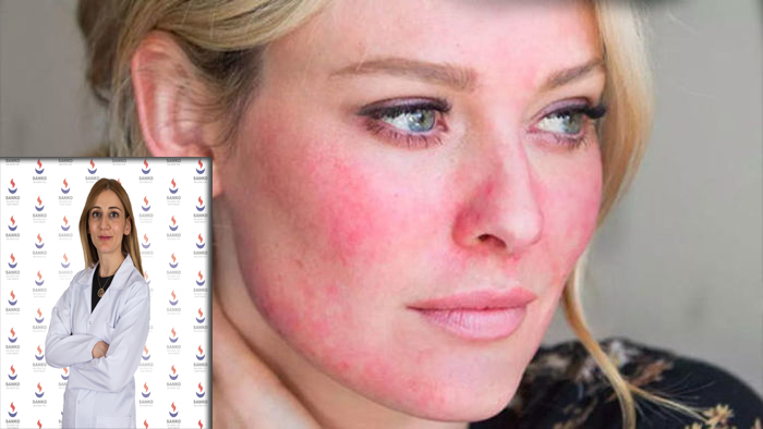 Roza Hastalığı Nasıl Kontrol Altına Alınır?